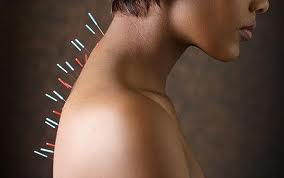 how acupuncture can help you